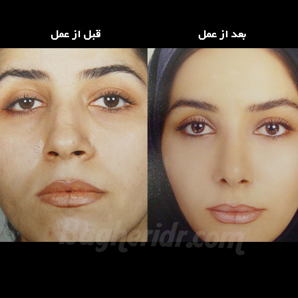 1260974436_جراحی زیبایی بینی و چانه